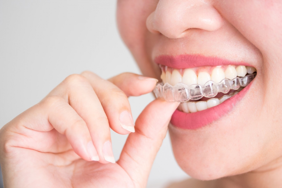 La Ortodoncia Fija: Una Solución Eficaz para una Sonrisa Perfecta 1 La Ortodoncia Fija: Una Solución Eficaz para una Sonrisa Perfecta